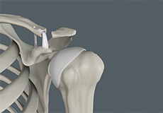 Acromioclavicular Joint (AC) Joint Reconstruction