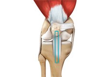 ACL Reconstruction of Patellar Tendon