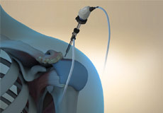 Arthroscopic Acromioplasty