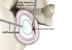 Capsular Release