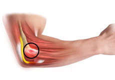 Common Extensor Tendon Origin Repair