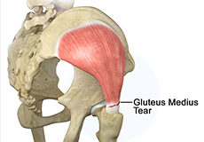 Gluteus Tendon Tear