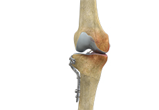 High Tibial Osteotomy