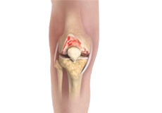 Knee Osteoarthritis