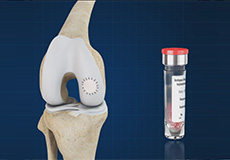 Matrix Induced Autologous Chondrocyte Implantation (MACI)