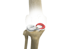 Medial Meniscus Syndrome