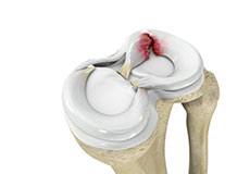 Meniscal Tears