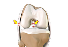 Multiligament Knee Injuries