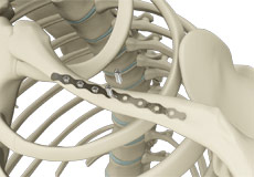 ORIF of the Clavicle Fractures