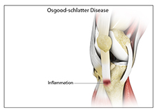 Osgood-Schlatter Disease