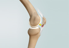 Patellar Tendinitis