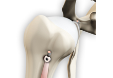 Proximal Biceps Tendinitis