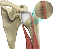 Proximal Biceps Tendon Rupture