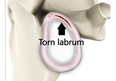 Shoulder Labral Tear