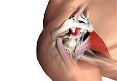 Subacromial Decompression