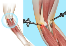 Tennis Elbow Surgery