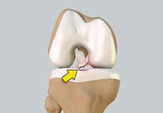 Tibial Eminence Fracture