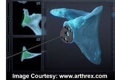 Virtual Implant Positioning by Arthrex